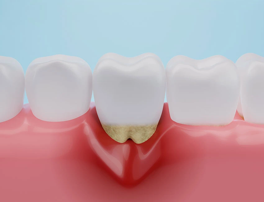 Periodontal Care at Canyon Country Dental Care