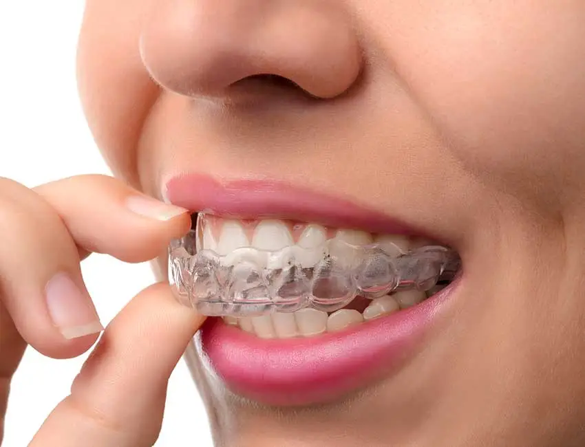 Mouthguards at Canyon Country Dental Care