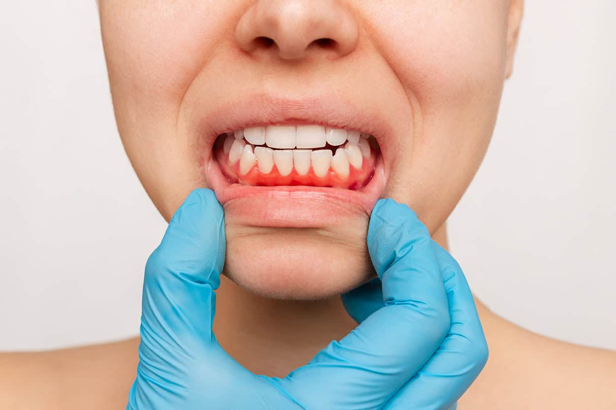 reverse gingivitis at home
