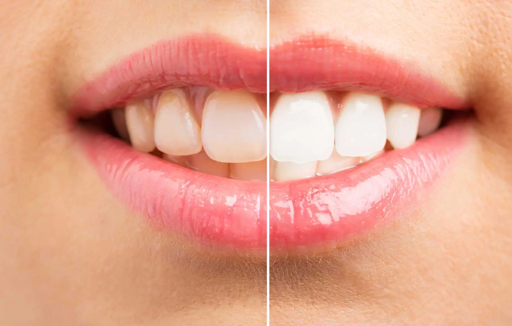 Before and after teeth whitening